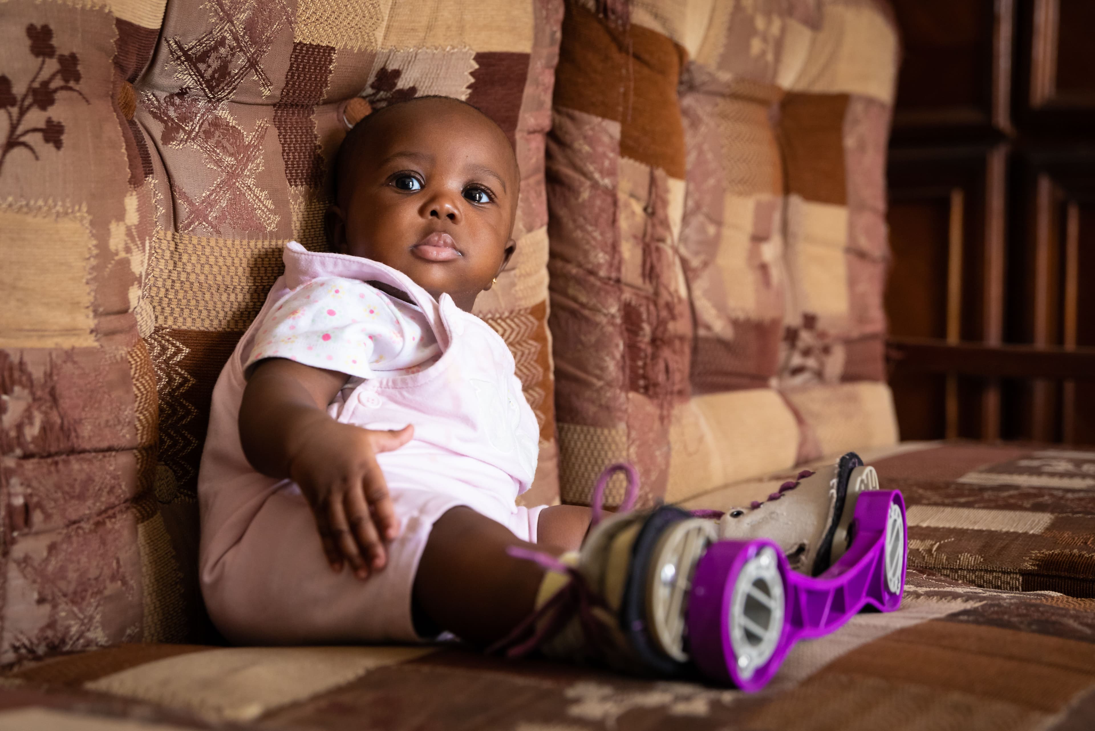 Baby girl in clubfoot treatment brace.